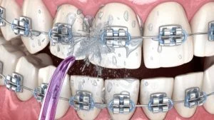 Máy tăm nước có khả năng làm sạch rất tốt cho người niềng răng